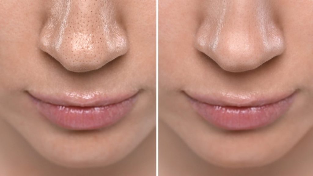 Porovnanie nosa pred a po odstránení čiernych bodiek