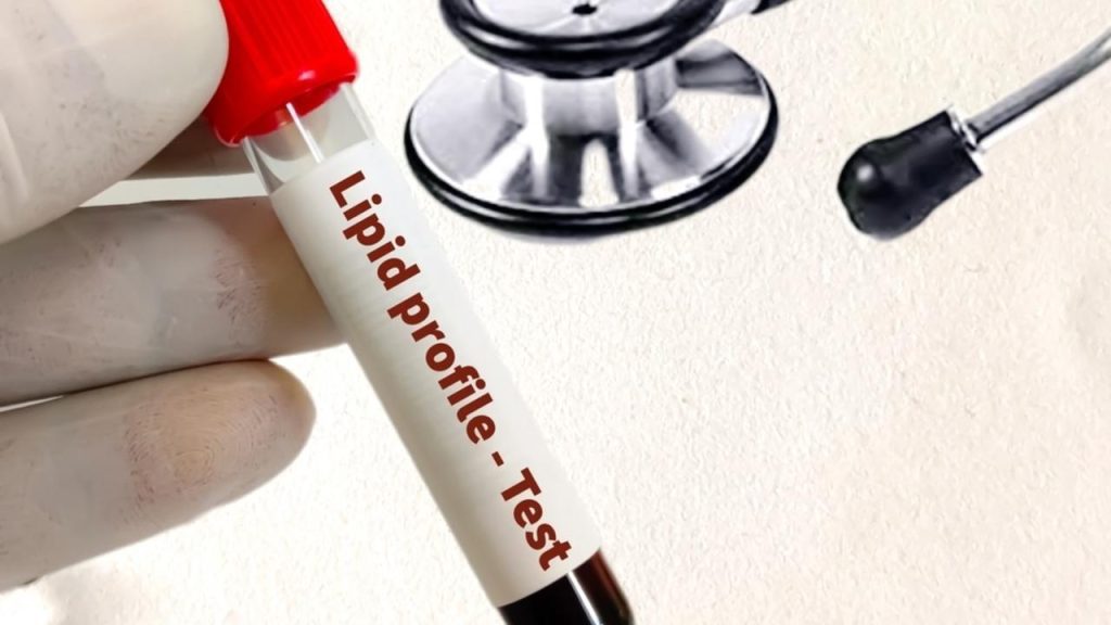 Skúmavka s označením „Lipid profile – Test“ držená v rukavici a stetoskop v pozadí, symbolizujúce vyšetrenie tukov v krvi.