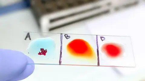 Sklíčko s kvapkami krvi pri teste krvných skupín A, B a D