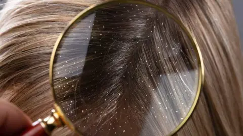 Detail pokožky hlavy s lupinami pod lupou
