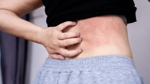 Žena si škriabe začervenanú podráždenú pokožku na boku tela, typické prejavy suchej alebo alergickej reakcie.