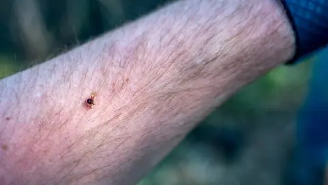 Detail kliešťa na koži, ktorý môže prenášať molekulu alfa-gal