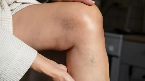 Zrelá žena sa stará o svoje nohy a boky. Natiera si krásnu nohu krémom na žilky. Starostlivosť o nohy. Žilové ochorenia – kŕčové žily